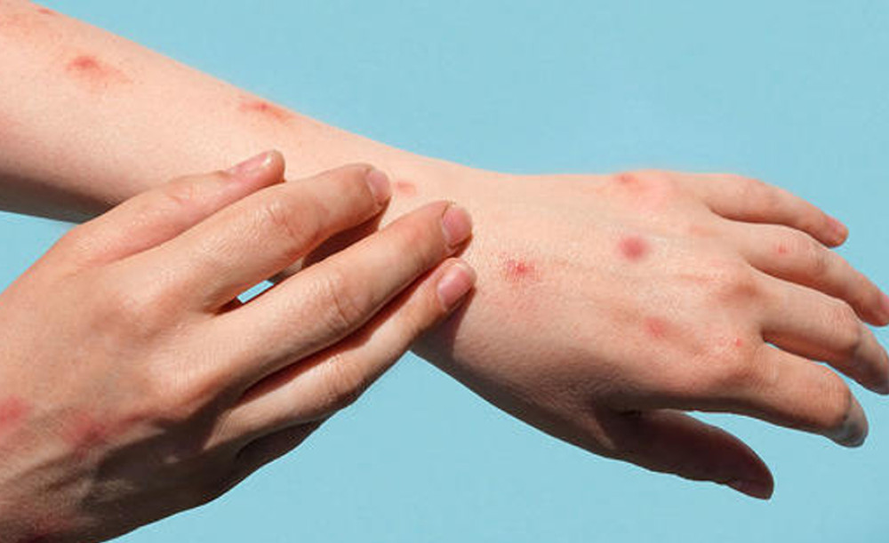 पहिलो पटक नेपालीलाई देखियो ‘मंकीपक्स’